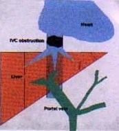 BUDD - CHIARI SYNDROME - SCHEMATIC ILLUSTRATION