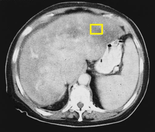 BUDD - CHIARI SYNDROME .  (Courtesy Dr . V . Penopoulos).