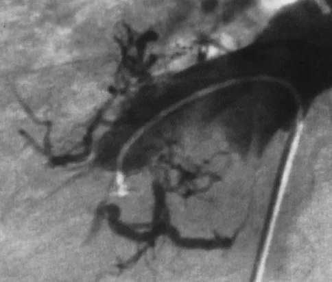 BUDD - CHIARI SYNDROME .  (Courtesy Dr . V . Penopoulos).