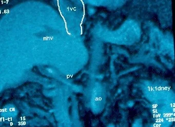 BUDD - CHIARI SYNDROME - MRI PHLEBOGRAPHY .(Courtesy Dr . V . Penopoulos).