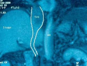 BUDD - CHIARI SYNDROME - MRI PHLEBOGRAPHY .  (Courtesy Dr . V . Penopoulos).