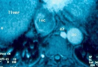 BUDD - CHIARI SYNDROME - MRI PHLEBOGRAPHY . (Courtesy Dr . V . Penopoulos).