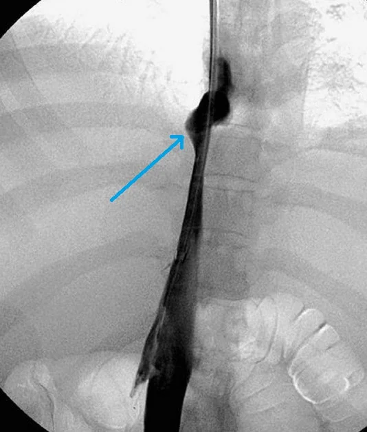 BUDD - CHIARI SYNDROME - CAVOGRAPHY . (Courtesy Dr . V . Penopoulos).