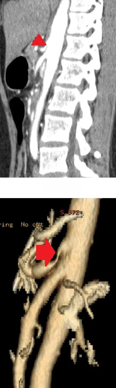 CELIAC ARTERY COMPRESSION SYNDROME . (Courtesy Dr . V . Penopoulos).