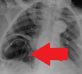 CHILAIDITI SYNDROME . (Courtesy Dr . V . Penopoulos).