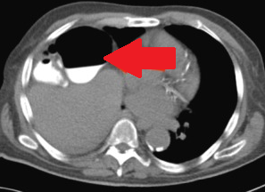CHILAIDITI SYNDROME . (Courtesy Dr . V . Penopoulos).