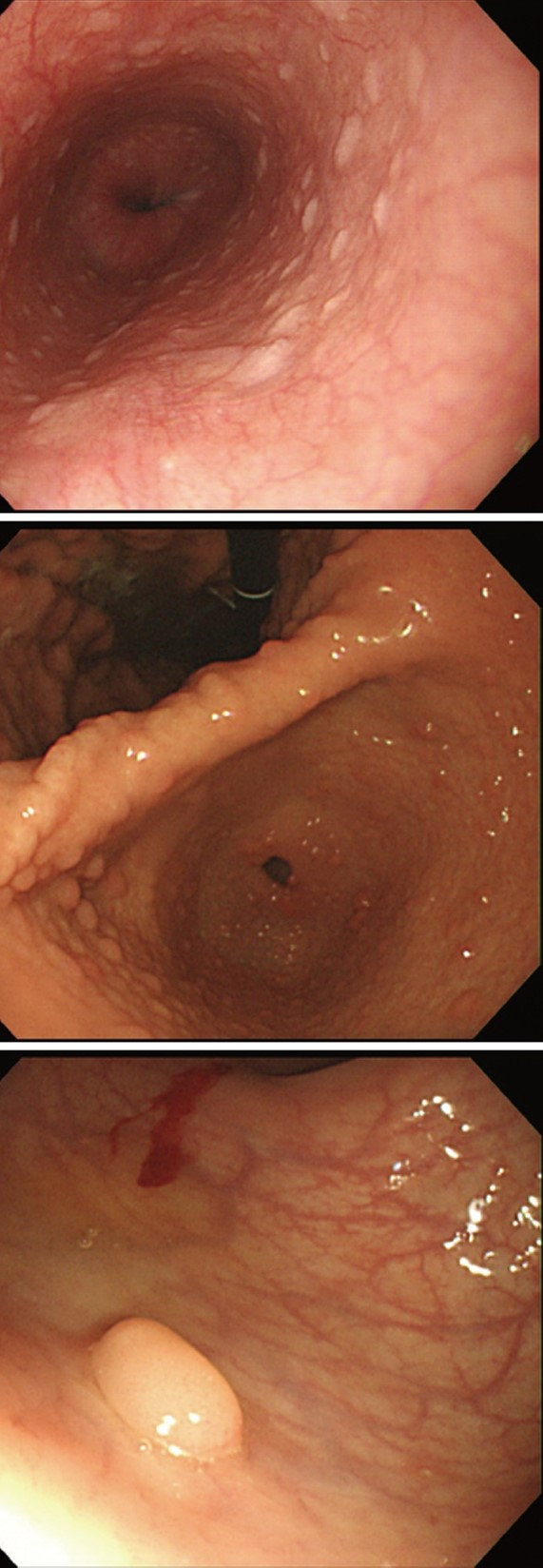 COWDEN SYNDROME - MULTIPLE GASTRIC POLYPOSIS . (Courtesy Dr . V . Penopoulos).