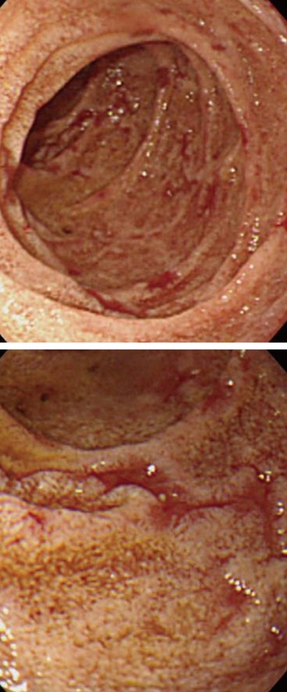 FAMILIAL MEDITERRANEAN FEVER-AMYLOIDOSIS . (Courtesy Dr . V . Penopoulos).