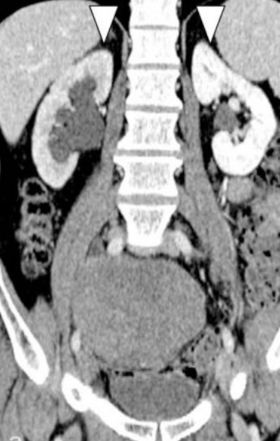 GARDNER'S SYNDROME - HYDRONEPHROSIS . (Courtesy Dr . V . Penopoulos).
