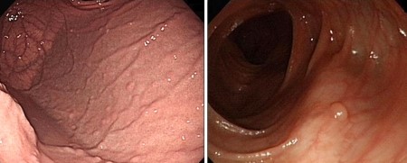GARDNER'S SYNDROME - ADENOMATOUS POLYPOSIS . (Courtesy Dr . V . Penopoulos).