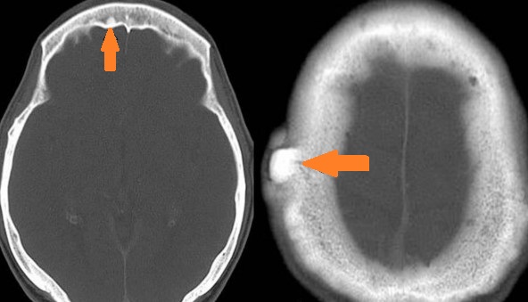 GARDNER'S SYNDROME - OSTEOMA .  (Courtesy Dr . V . Penopoulos).