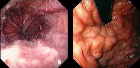 KASABACH MERRIT SYNDROME .  (Courtesy Dr . V . Penopoulos).