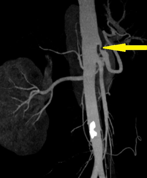 MEDIAN ARCUATE LIGAMENT SYNDROME . (Courtesy Dr . V . Penopoulos).