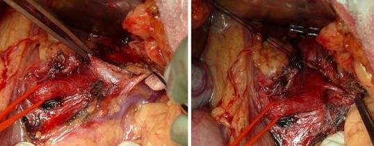 MEDIAN ARCUATE LIGAMENT SYNDROME .  (Courtesy Dr . V . Penopoulos).
