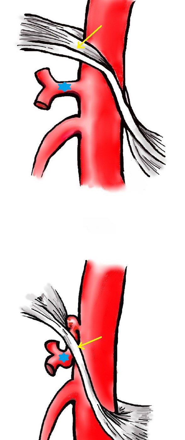 MEDIAN ARCUATE LIGAMENT SYNDROME 