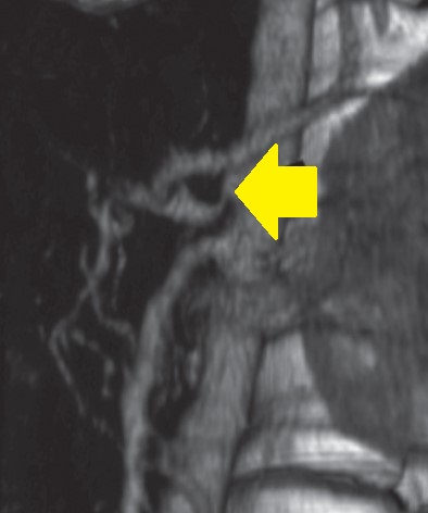 MEDIAN ARCUATE LIGAMENT SYNDROME . (Courtesy Dr . V . Penopoulos).