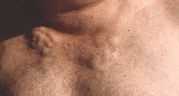 MEDIASTINAL SYNDROME .  (Courtesy Dr . V . Penopoulos).