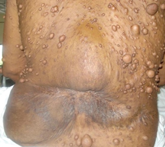 NEUROFIBROMATOSIS . (Courtesy Dr . V . Penopoulos).