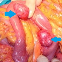 NEUROFIBROMATOSIS - GISTs . (Courtesy Dr . V . Penopoulos).