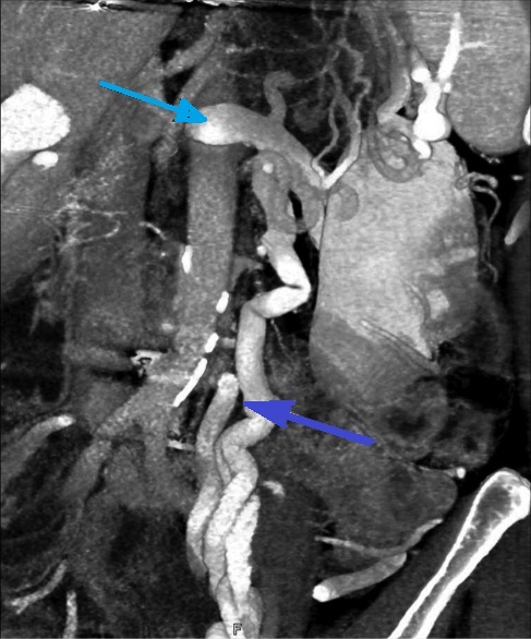 NUTCRACKER SYNDROME - DILATED SEMINAL VEIN . (Courtesy Dr . V . Penopoulos).
