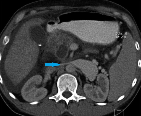 NUTCRACKER SYNDROME . (Courtesy Dr . V . Penopoulos).