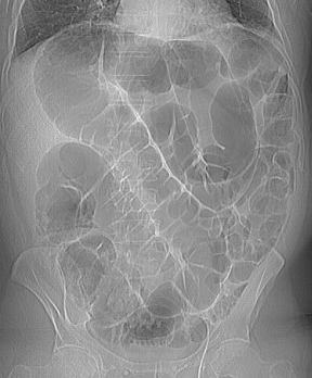 OGILVIE'S SYNDROME .  (Courtesy Dr . V . Penopoulos).