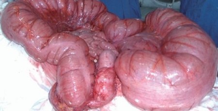 OGILVIE'S SYNDROME. (Courtesy Dr . V . Penopoulos).
