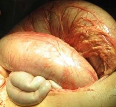 OGILVIE'S SYNDROME . (Courtesy Dr . V . Penopoulos).