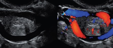 PELVIC CONGESTION SYNDROME . (Courtesy Dr . V . Penopoulos).
