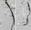 PELVIC CONGESTION SYNDROME - OVARIAN PHLEBOGRAPHY . (Courtesy Dr . V . Penopoulos).