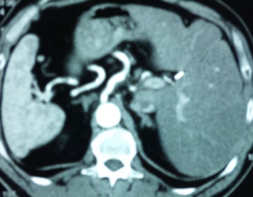 SITUS INVERSUS TOTALIS . (Courtesy Dr . V . Penopoulos).