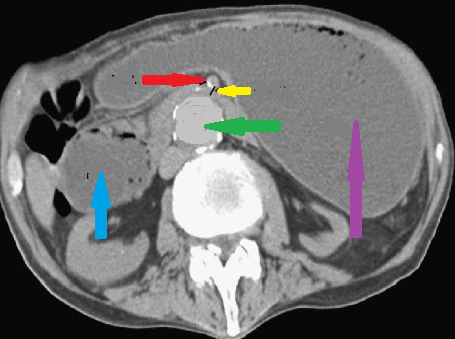 SUPERIOR MESENTERIC ARTERY SYNDROME . (Courtesy Dr . V . Penopoulos).