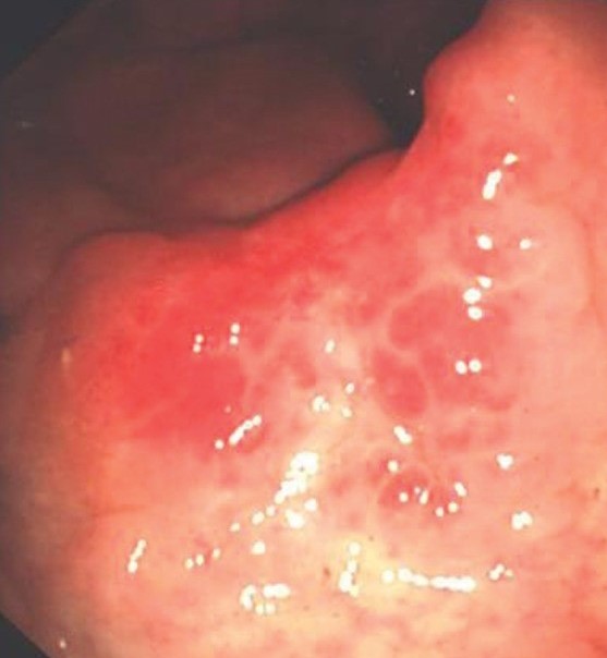 SOLITARY RECTAL ULCER SYNDROME . (Courtesy Dr . V . Penopoulos).