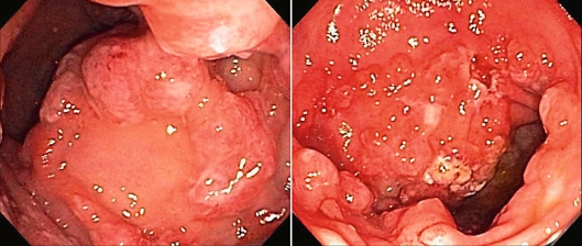 SOLITARY RECTAL ULCER SYNDROME . (Courtesy Dr . V . Penopoulos).