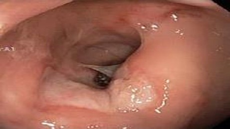 SOLITARY RECTAL ULCER SYNDROME . (Courtesy Dr . V . Penopoulos).
