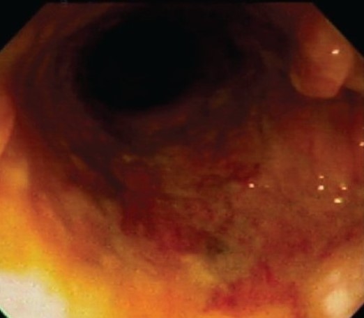 SOLITARY RECTAL ULCER SYNDROME . (Courtesy Dr . V . Penopoulos).