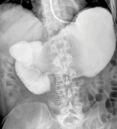SUPERIOR MESENTERIC ARTERY SYNDROME . (Courtesy Dr . V . Penopoulos).
