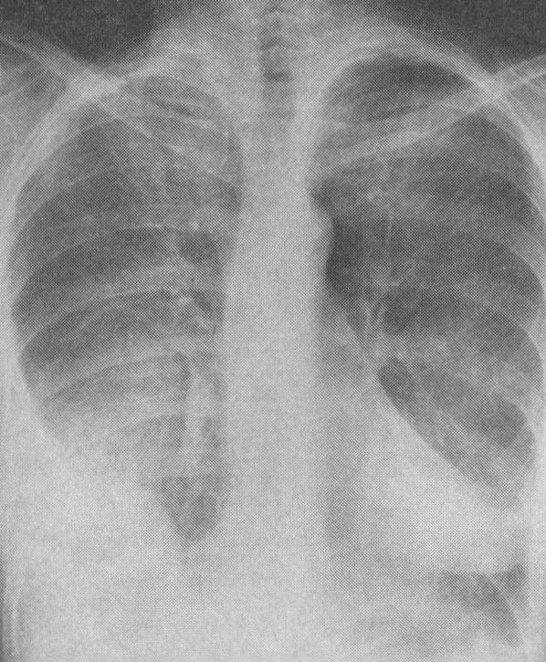 YELLOW NAIL SYNDROME - BILATERAL PLEURAL EFFUSIONS . (Courtesy Dr . V . Penopoulos).