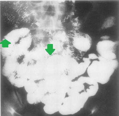YELLOW NAIL SYNDROME - INTESTINAL LYMPHANGIECTASIA . (Courtesy Dr . V . Penopoulos).