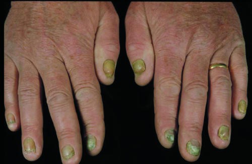 YELLOW NAIL SYNDROME . (Courtesy Dr . V . Penopoulos).