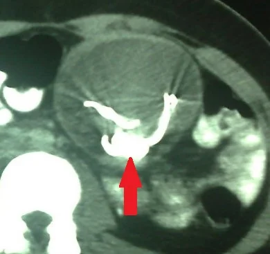 ABDOMINAL GOSSYPIBOMA