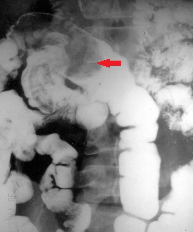 GOSSYPIBOMA - BOWEL OBSTRUCTION