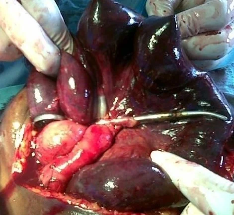 GOSSYPIBOMA - RETAINED ARTERY FORCEPS