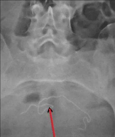 GOSSYPIBOMA - ABDOMINAL X - RAY