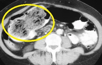 GOSSYPIBOMA - ABDOMINAL CT SCAN