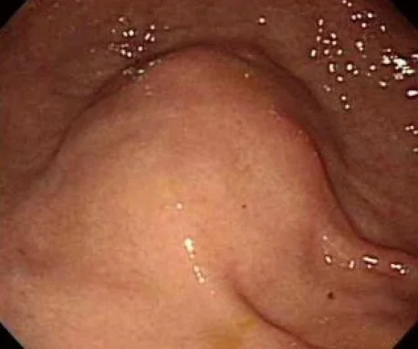 GOSSYPIBOMA - ENDOSCOPIC IMAGE