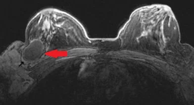 GOSSYPIBOMA - BREAST