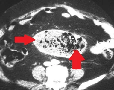 INTRABDOMINAL GOSSYPIBOMA - CT SCAN IMAGE