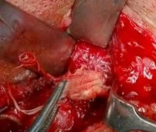 SUBMANDIBULAR GOSSYPIBOMA