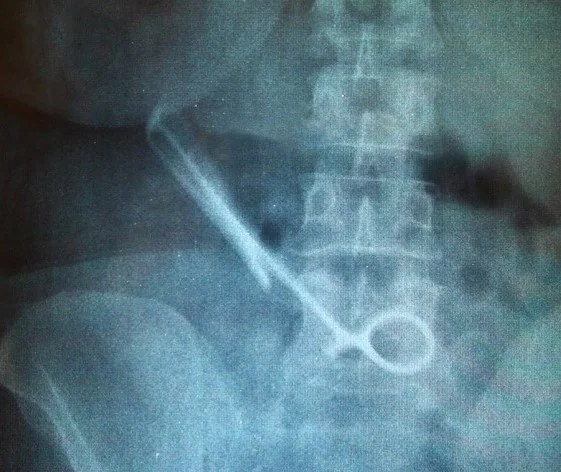 GOSSYPIBOMA - SURGICAL INSTRUMENT